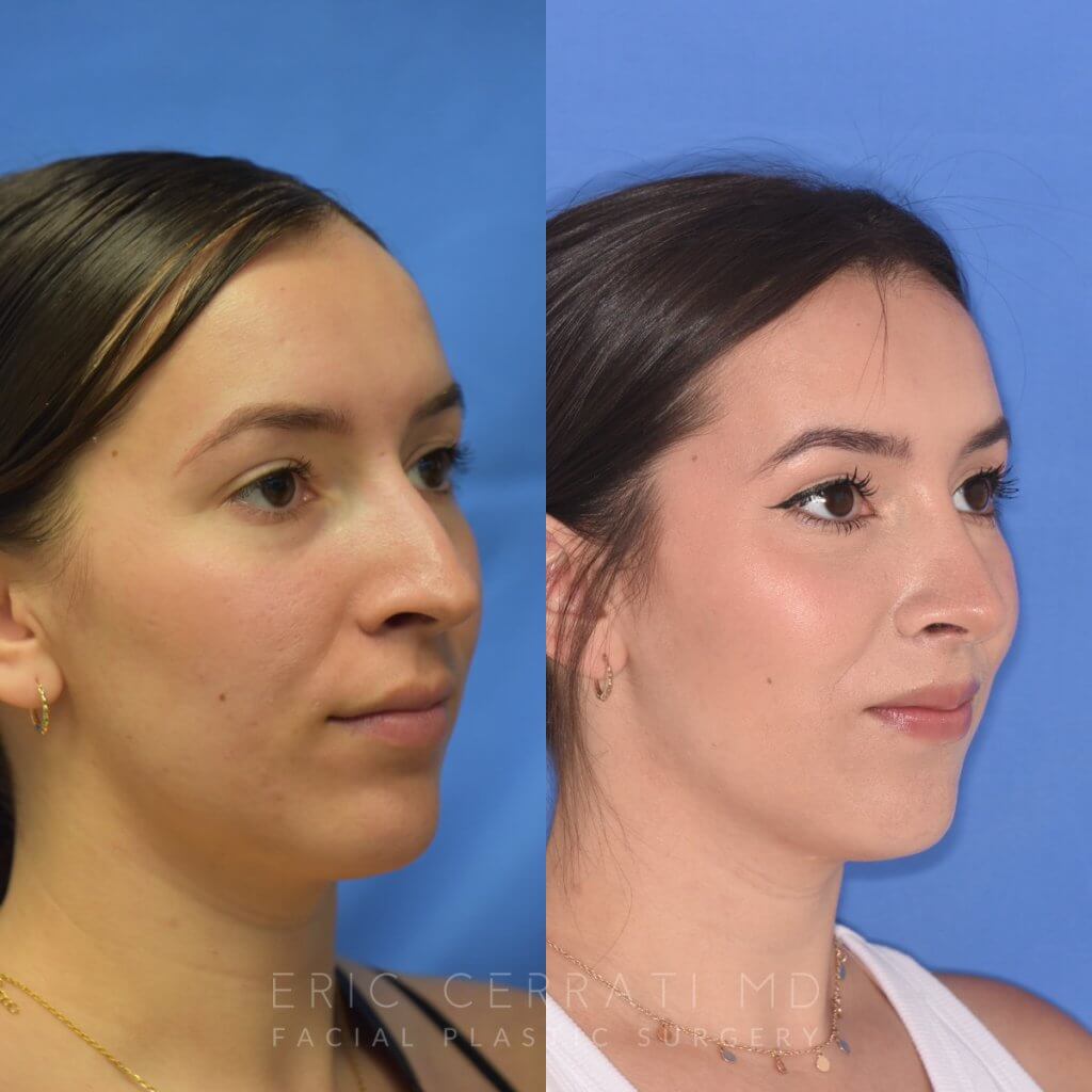 Female patient before and after rhinoplasty - right side