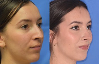 Female patient before and after rhinoplasty - right side