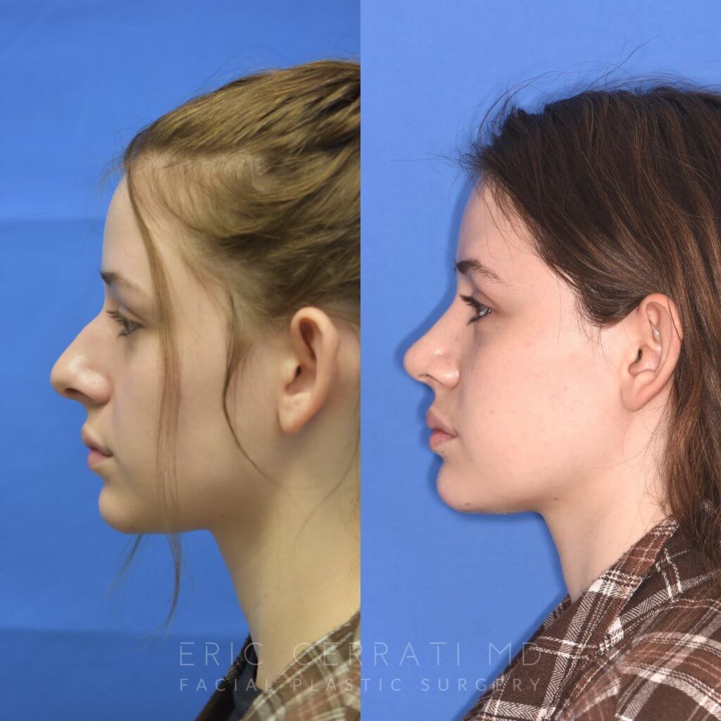 Female patient before and after rhinoplasty procedure