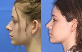 Female patient before and after rhinoplasty procedure