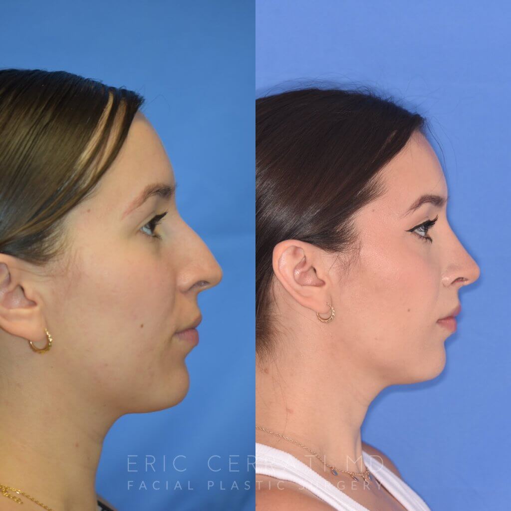 Female patient before and after rhinoplasty - right side