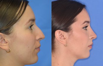 Female patient before and after rhinoplasty - right side