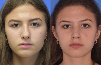 Female patient before and after rhinoplasty