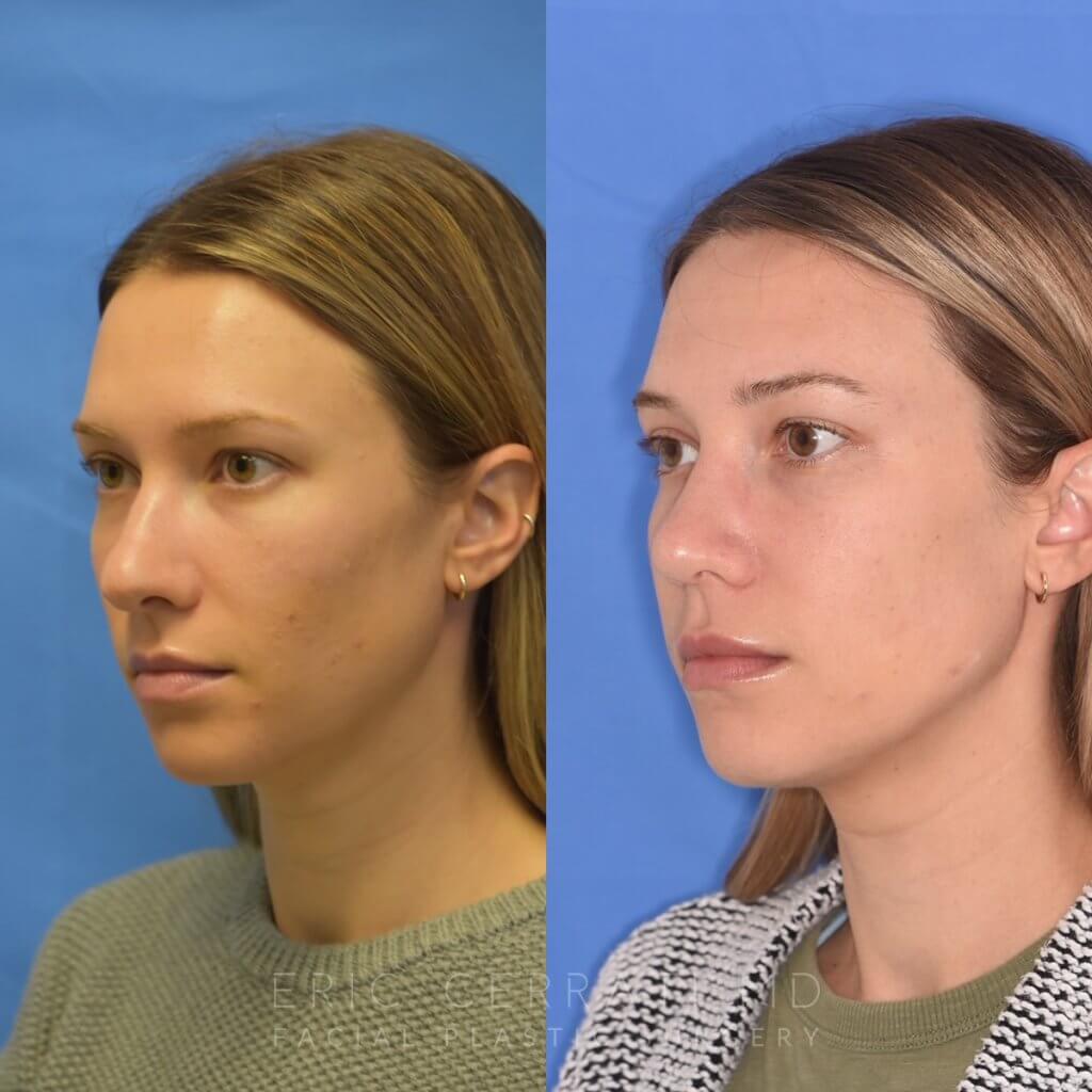Female patient before and after rhinoplasty