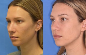 Female patient before and after rhinoplasty