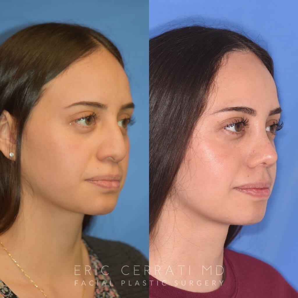 Female patient before and after rhinoplasty
