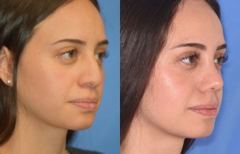 Female patient before and after rhinoplasty
