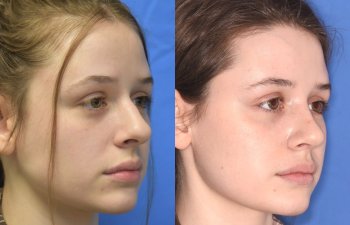 Female patient before and after rhinoplasty procedure