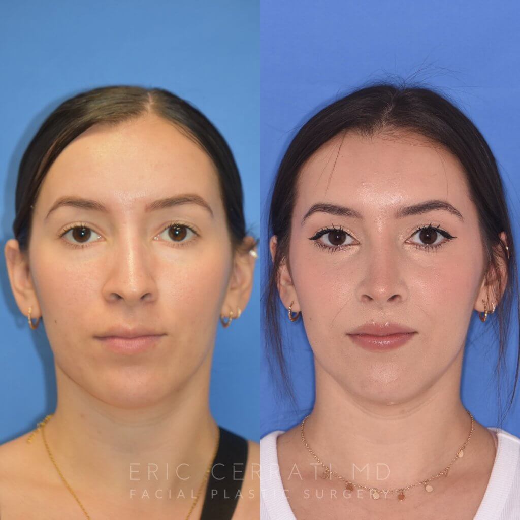 Female patient before and after rhinoplasty - front
