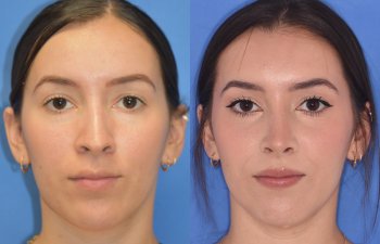Female patient before and after rhinoplasty - front