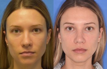 Female patient before and after rhinoplasty