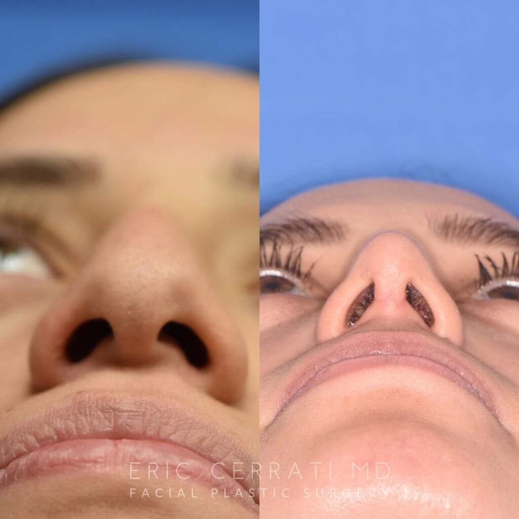 Female patient before and after rhinoplasty