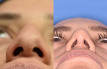 Female patient before and after rhinoplasty