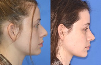 Female patient before and after rhinoplasty procedure