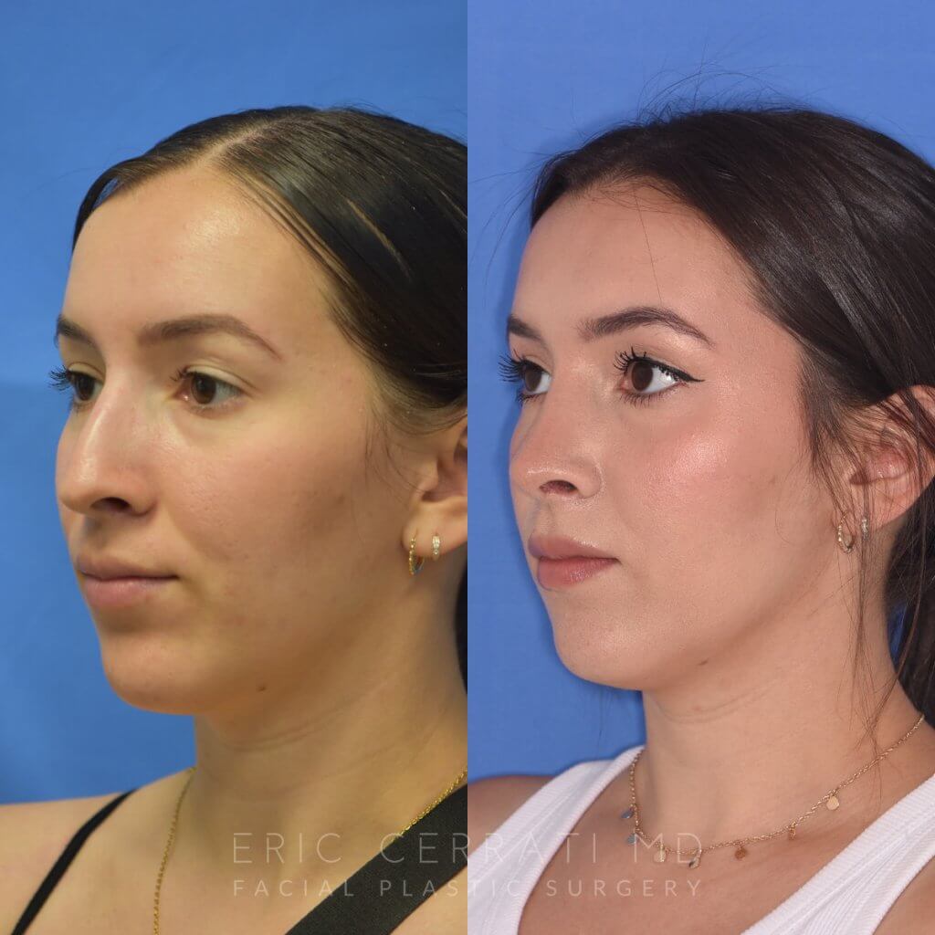 Female patient before and after rhinoplasty - left side