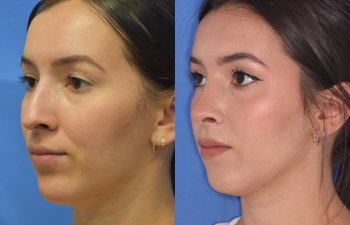 Female patient before and after rhinoplasty - left side