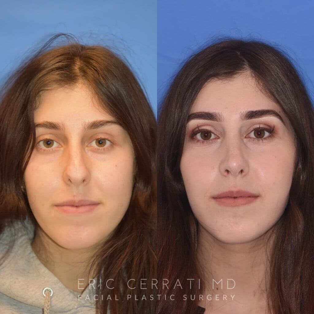 Female patient before and after rhinoplasty