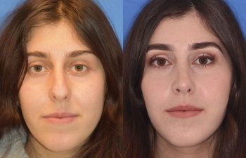 Female patient before and after rhinoplasty