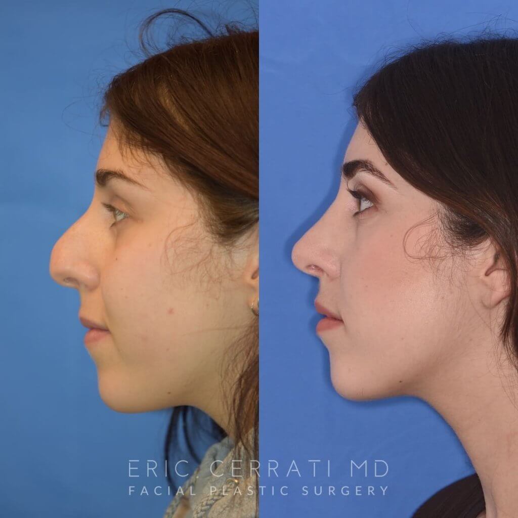 Female patient before and after rhinoplasty