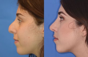 Female patient before and after rhinoplasty