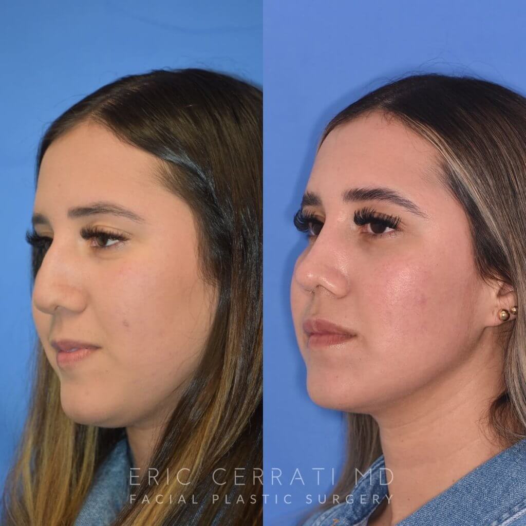 Female patient before and after rhinoplasty