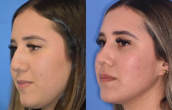 Female patient before and after rhinoplasty