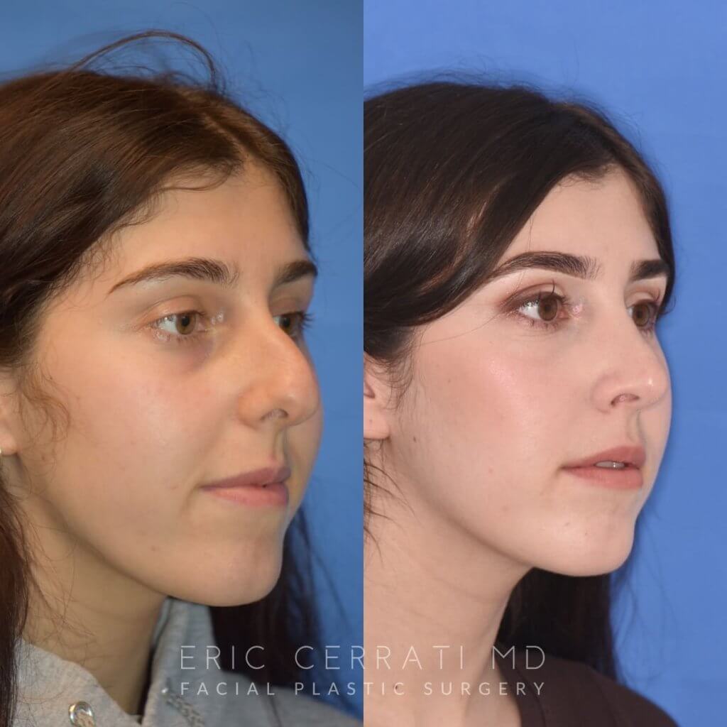 Female patient before and after rhinoplasty