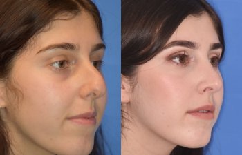 Female patient before and after rhinoplasty