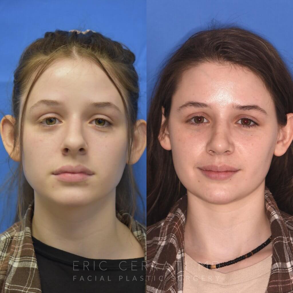 Female patient before and after rhinoplasty procedure