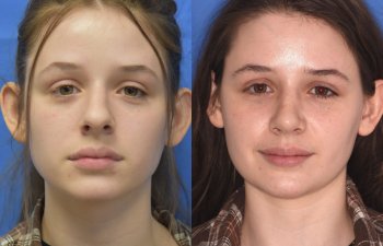 Female patient before and after rhinoplasty procedure