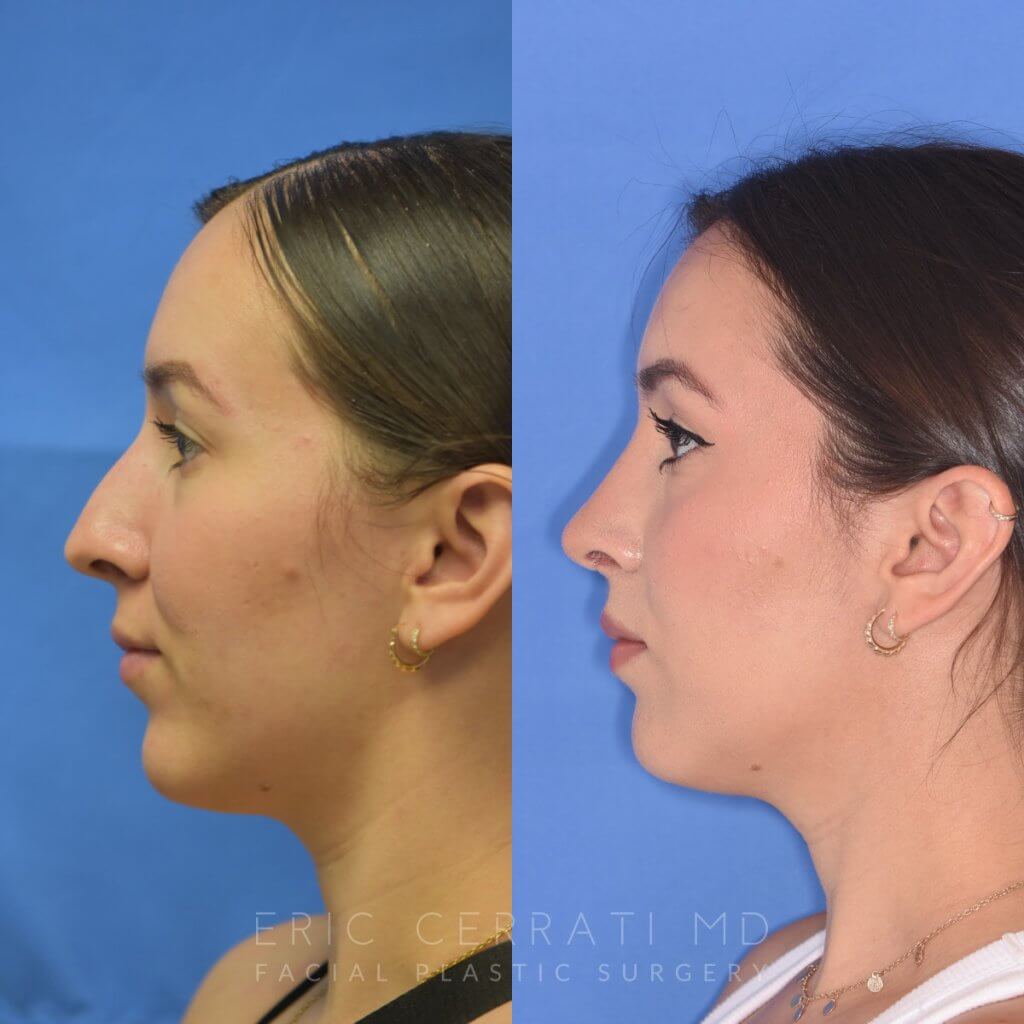 Female patient before and after rhinoplasty - left side