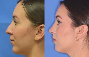 Female patient before and after rhinoplasty - left side