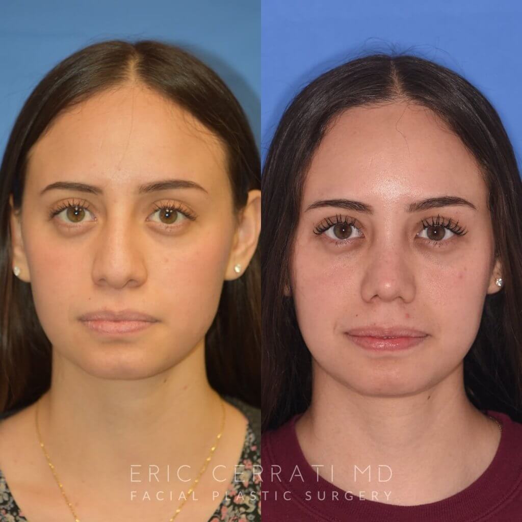 Female patient before and after rhinoplasty