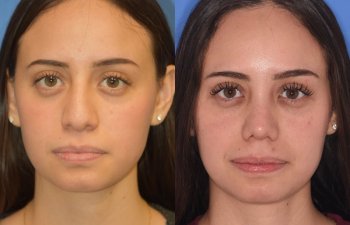 Female patient before and after rhinoplasty