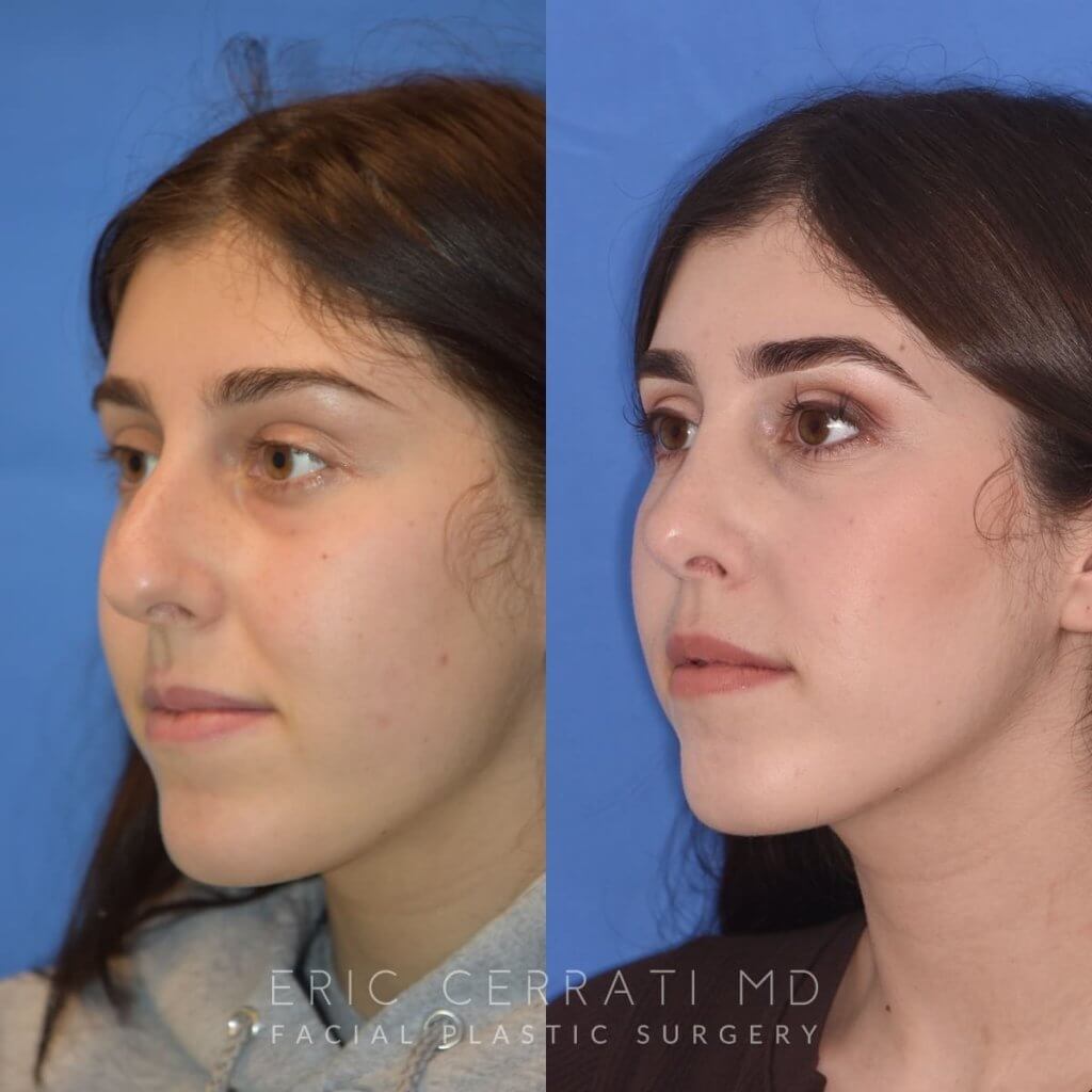 Female patient before and after rhinoplasty