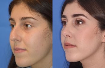 Female patient before and after rhinoplasty