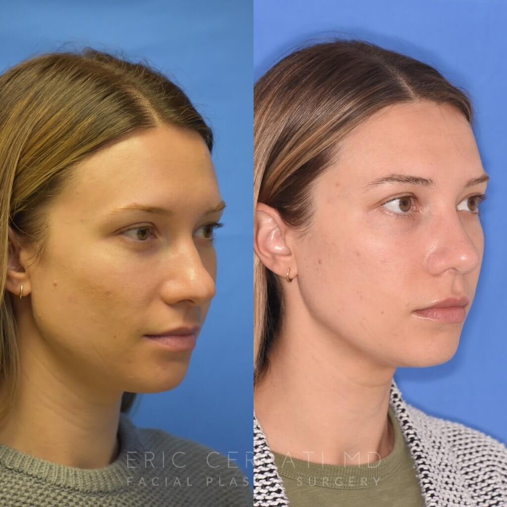 Female patient before and after rhinoplasty
