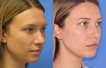 Female patient before and after rhinoplasty