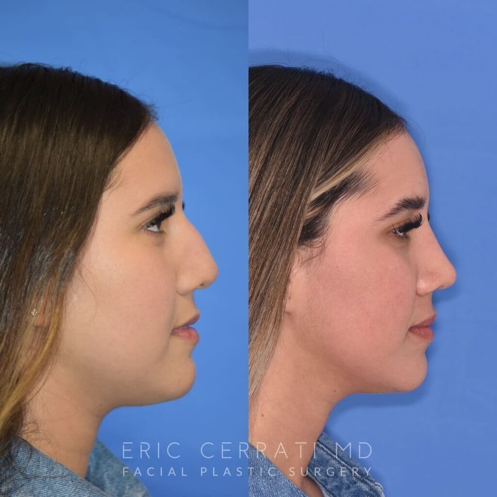 Female patient before and after rhinoplasty