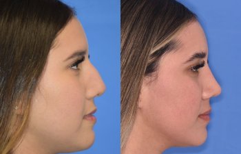 Female patient before and after rhinoplasty