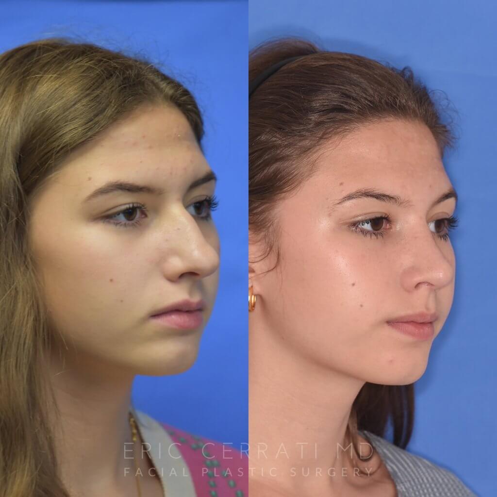 Female patient before and after rhinoplasty
