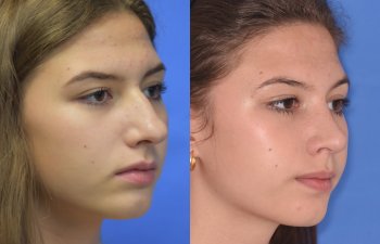 Female patient before and after rhinoplasty