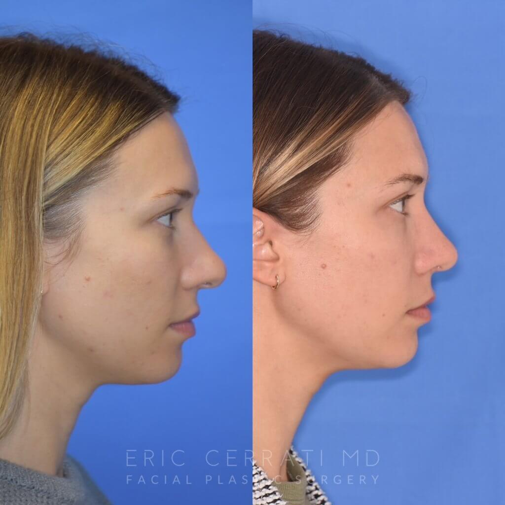Female patient before and after rhinoplasty