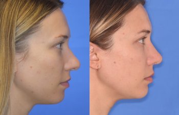 Female patient before and after rhinoplasty