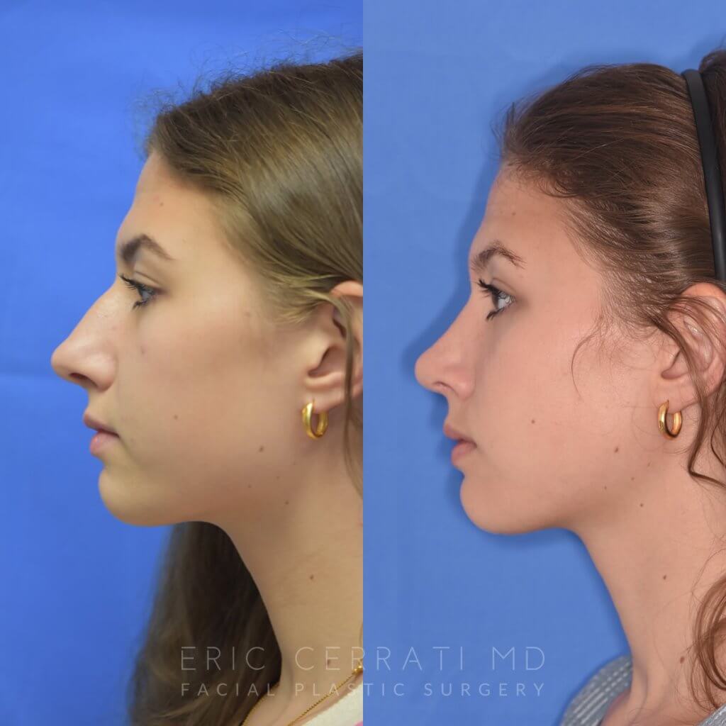 Female patient before and after rhinoplasty