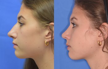 Female patient before and after rhinoplasty
