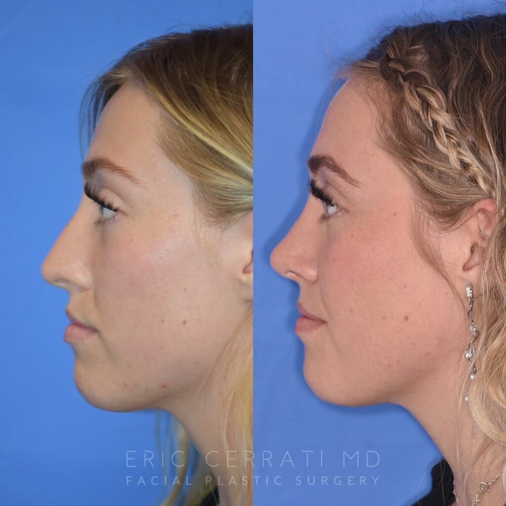Female patient before and after rhinoplasty