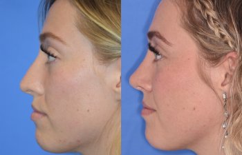 Female patient before and after rhinoplasty