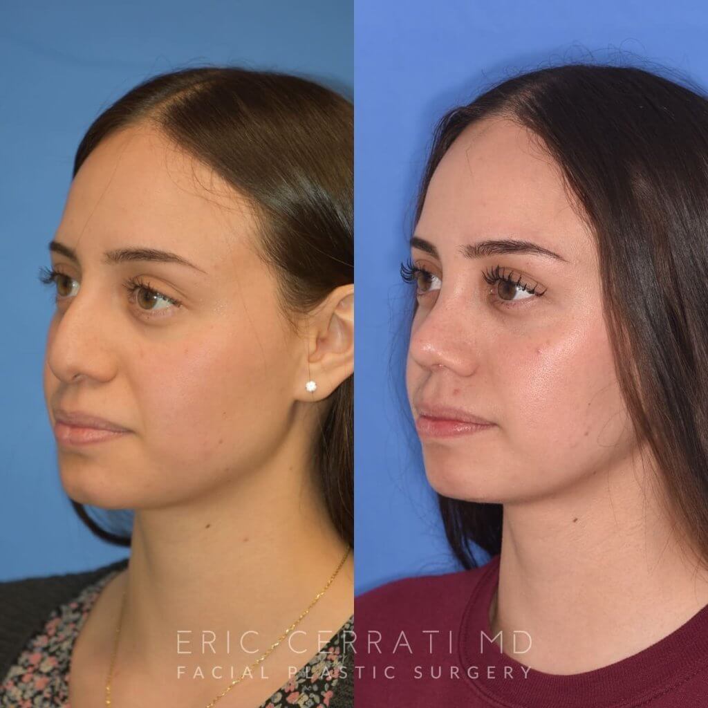 Female patient before and after rhinoplasty