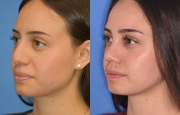 Female patient before and after rhinoplasty
